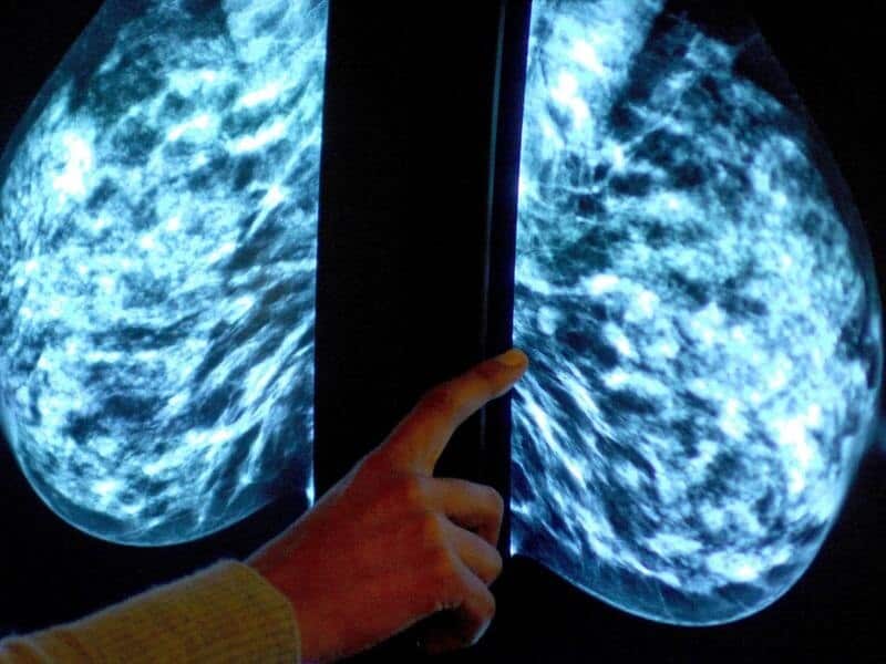 Breast cancer scan