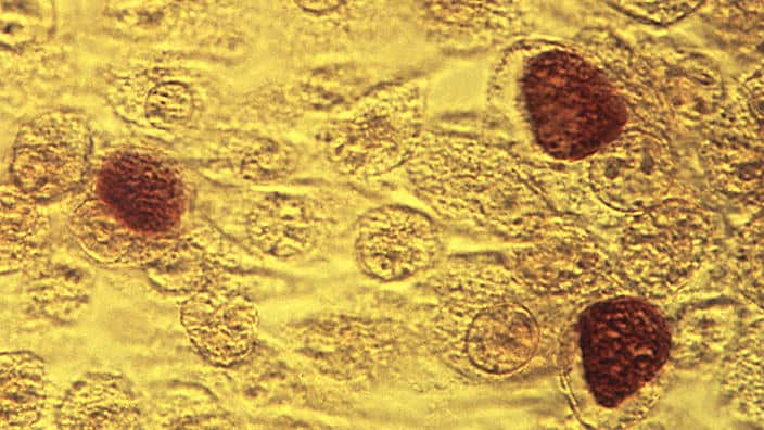  Chlamydia is rising but HIV rates remain stable, says a new report card on Australian sexual health. (AAP) 