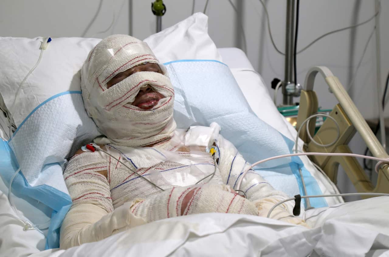 A person who was injured in a fuel tanker explosion in Akkar receives treatment at the intensive care room in Geitaoui hospital 