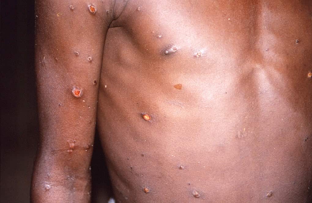 A patient whose skin displayed a number of lesions due to what had been an active case of monkeypox. 