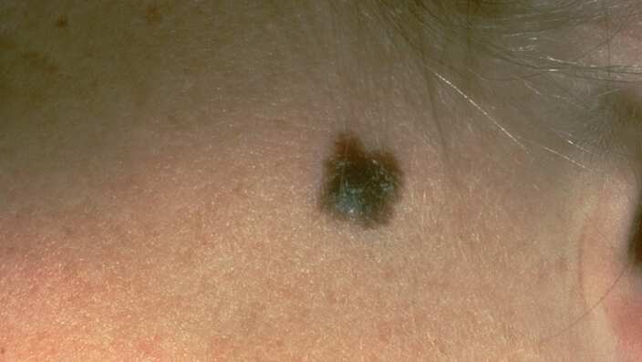 A suspicious mole that was diagnosed as a melanoma.