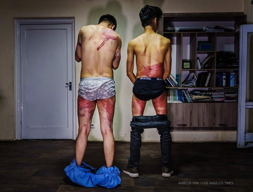 Afghan journalists Nemat Naqdi and Taqi Daryabi show injuries on their backs reportedly caused by the Taliban.