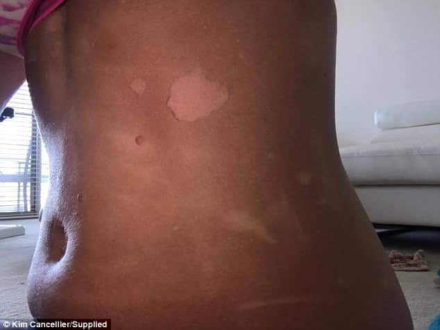 Bác sĩ cho biết đây là vết bỏng gây ra bởi phản ứng hóa học của kem chống nắng với da.