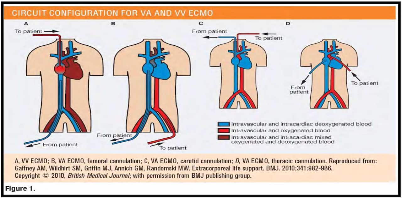 ECMO
