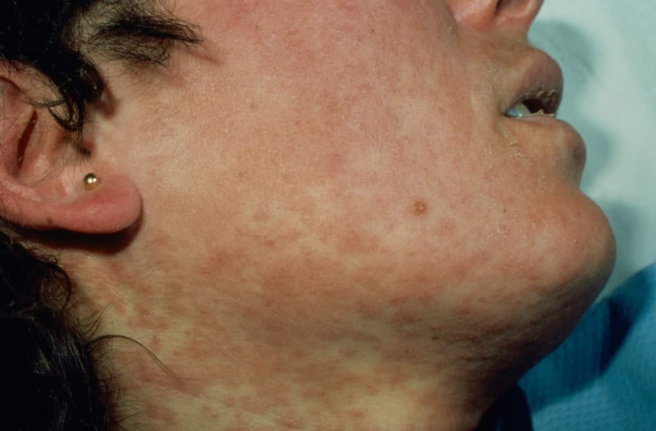 File image of a measles sufferer.