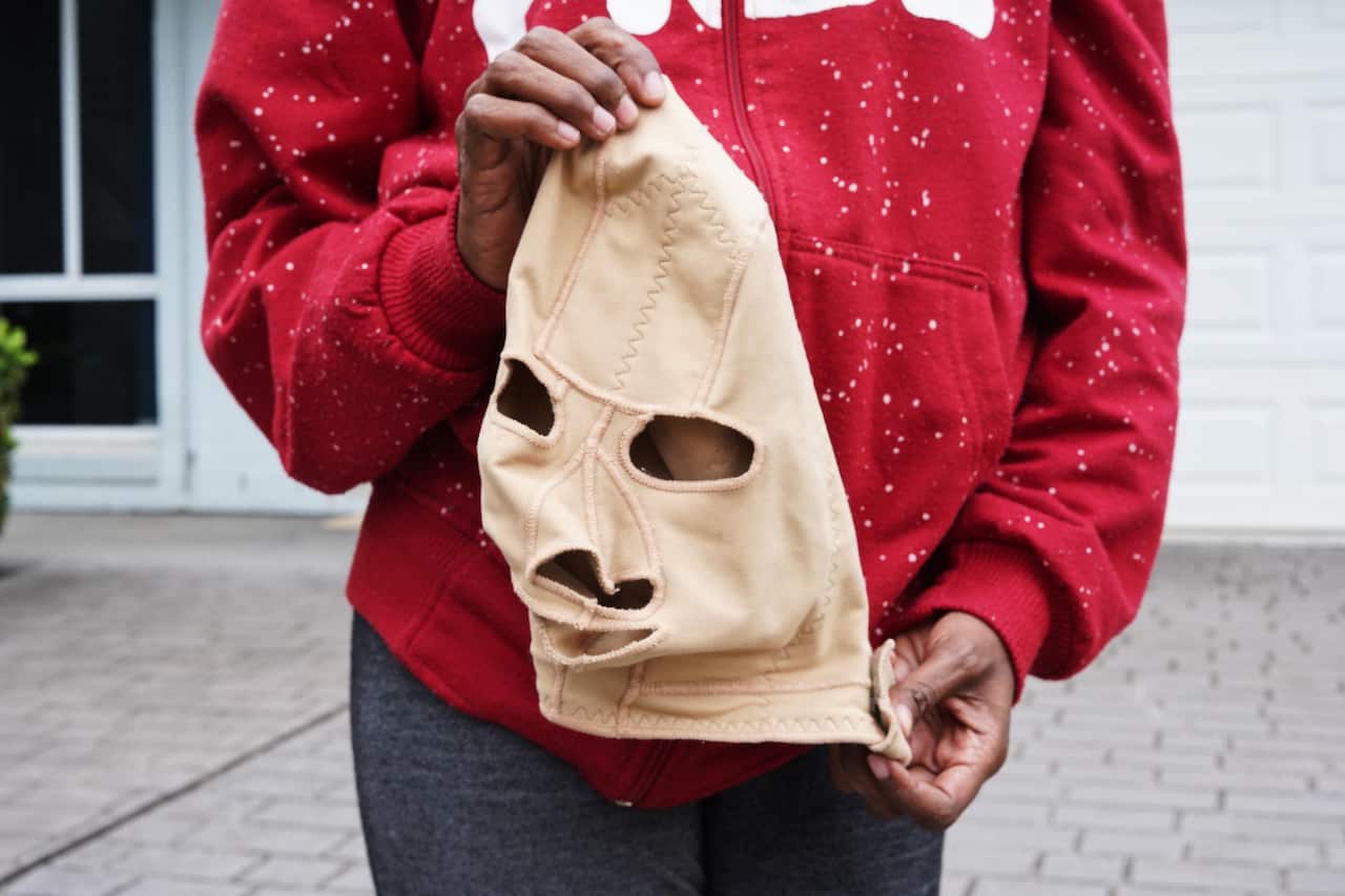 She still has to wear a mask because of the swelling.