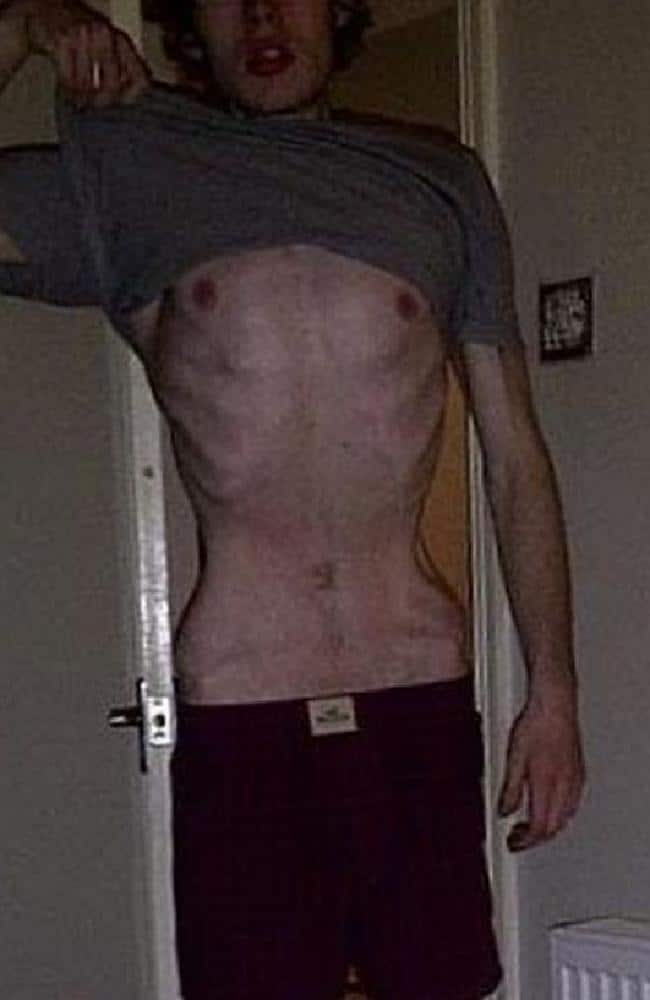 Stevie Brazier developed anorexia and bulimia after taking a diet pact with his mother too far.
