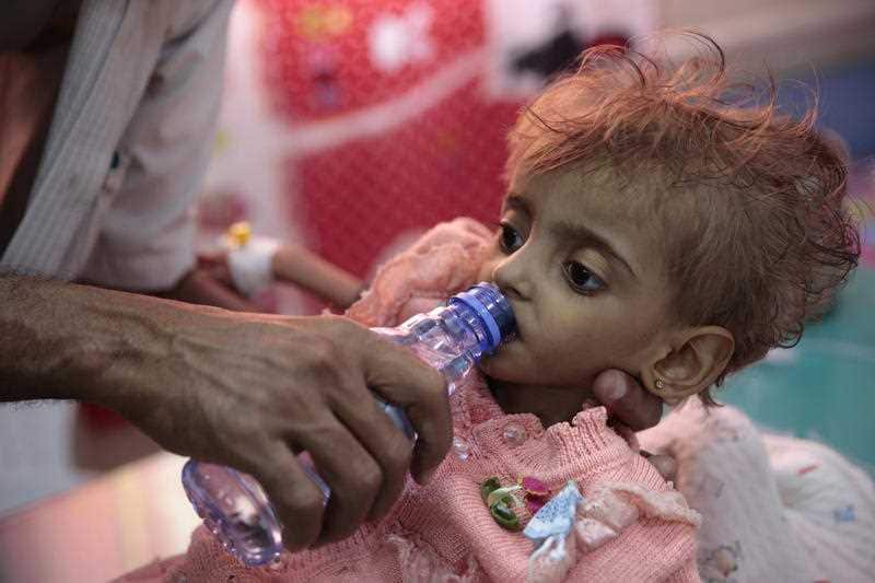 A father gives water to his malnourished daughter at a feeding center in a hospital in Hodeida, Yemen.