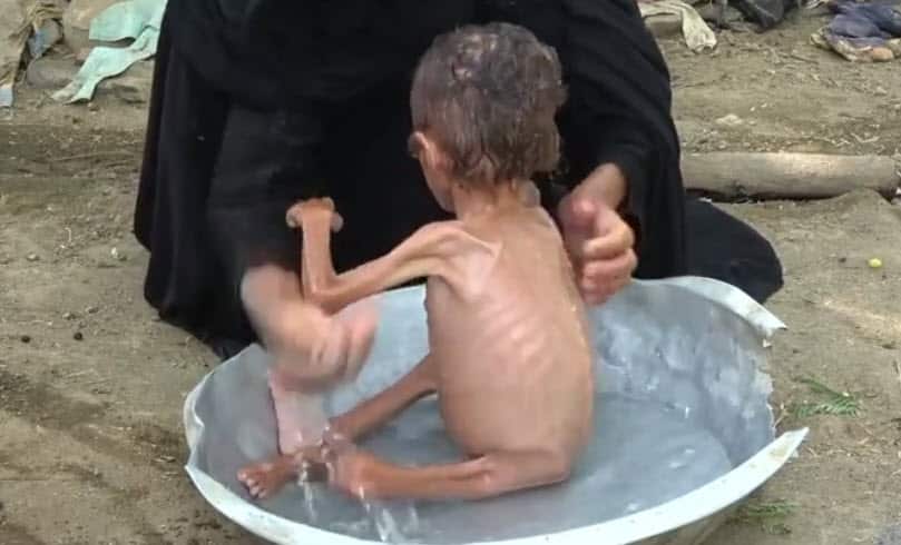 Yemen’s conflict has pushed what was already one of the poorest Arab states to the brink of famine. 