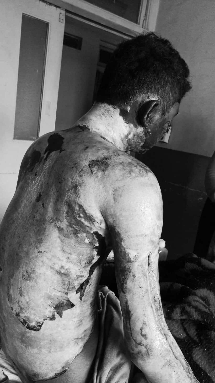 Acid Attack Nepal