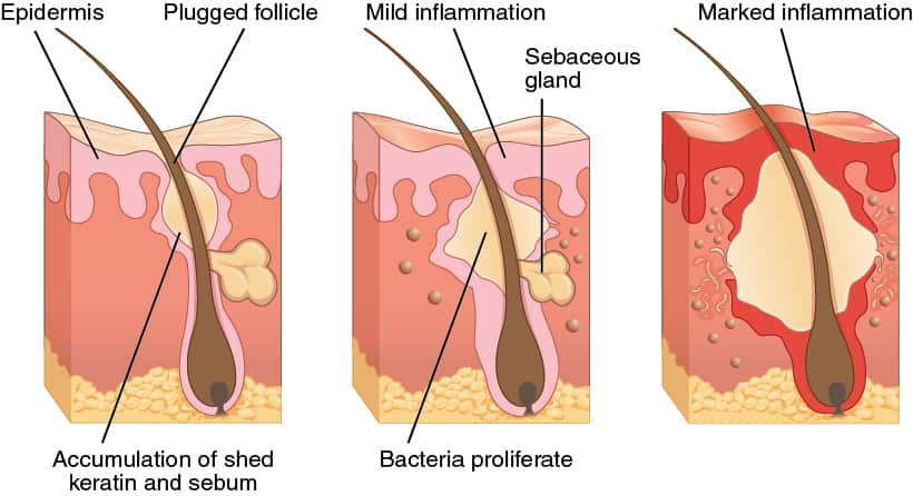 Acne formation