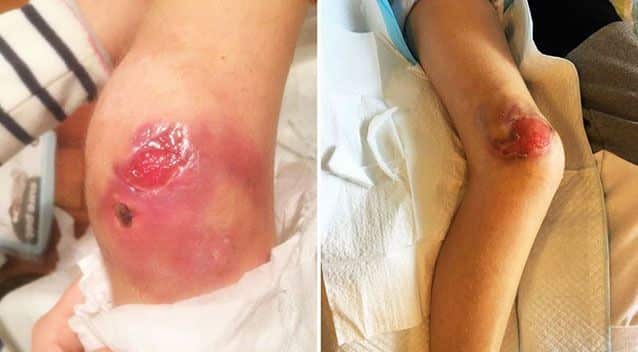 Mysterious flesh-eating ulcer cases soar on Mornington Peninsula.