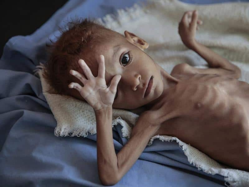 A severely malnourished boy in a hospital in Yemen