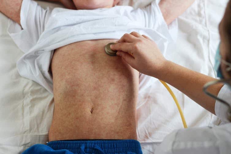 A rash is one of the defining symptoms of measles.