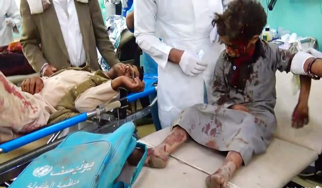Wounded Yemeni children lying on hospital beds after being injured in an alleged Saudi-led airstrike in the northern province of Saada, Yemen. 
