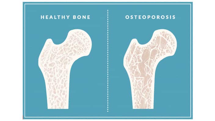 Healthy bone vs osteoporosis