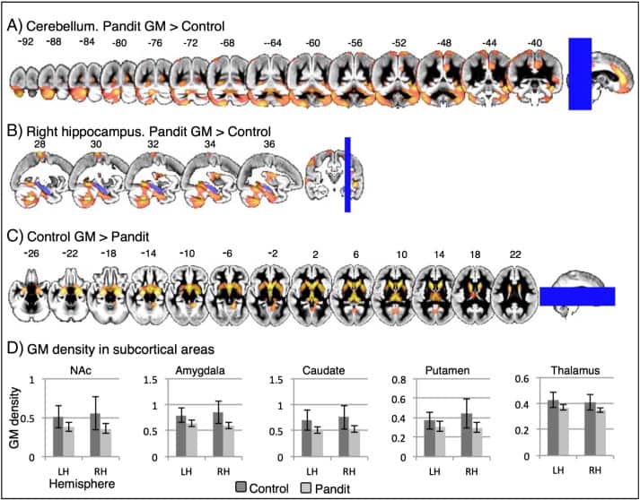 'Whole-brain VBM results in subcortical and cerebellar regions, overlaid onto the group GM template (left hemisphere on left).'