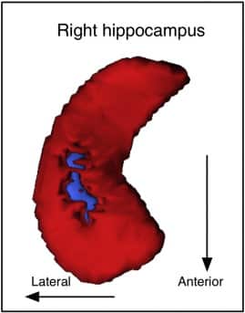 'Hippocampal region-of-interest analysis: areas within right hippocampus with less local volume for Pandits (in blue)'