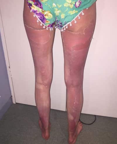 Briar Houston's burns to her legs and feet and was left in a “world of pain” after applying SPF 50+ spray sunscreen during a trip to Perth work
