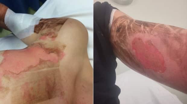 Mother suffers horrific burns after Thermomix bursts open