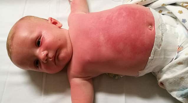 Bé sơ sinh 3 tháng bị dị ứng với kem chống nắng