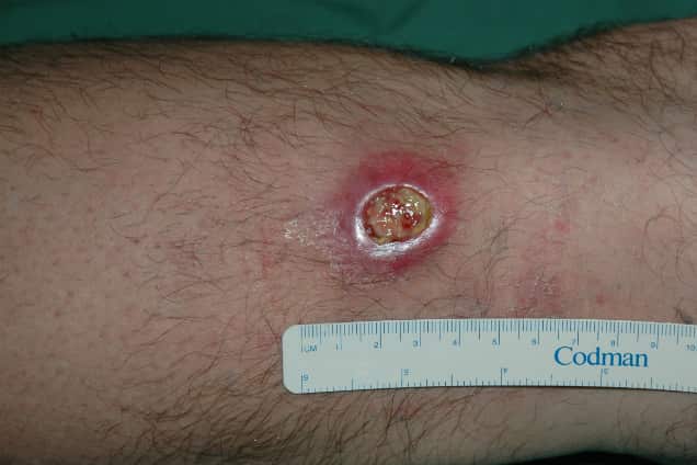 Buruli Ulcer