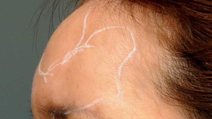 Janet Kim's forehead with inflammation