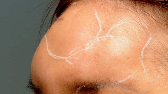 Janet Kim's forehead with inflammation