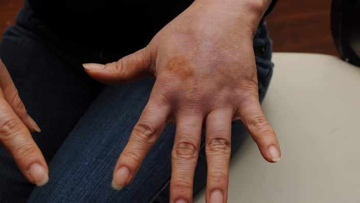 Janet Kim's hands with inflammation
