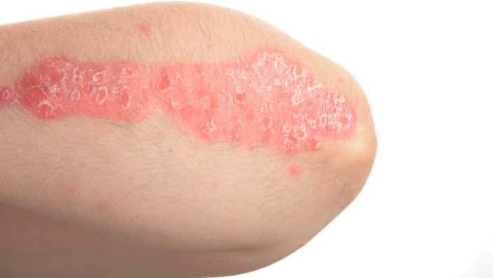 Psoriasis, dermatologic diseases.