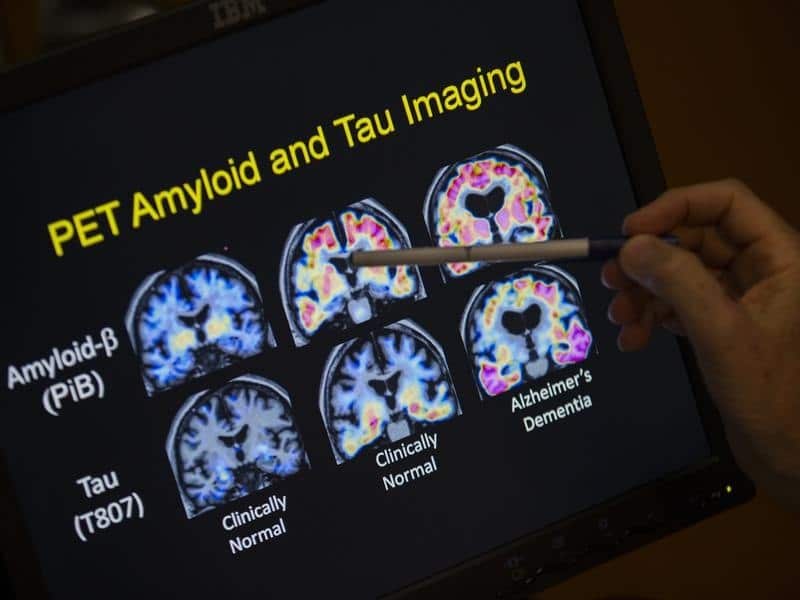 PET scan results that are part of a study on Alzheimer's disease