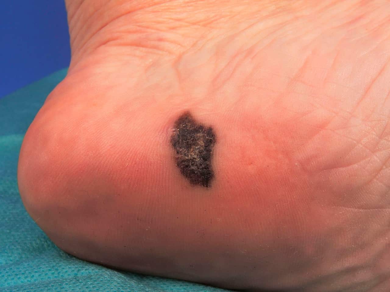Acral lentiginous melanoma of the sole, level 1.