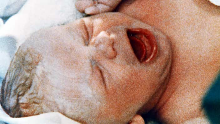 First IVF Baby