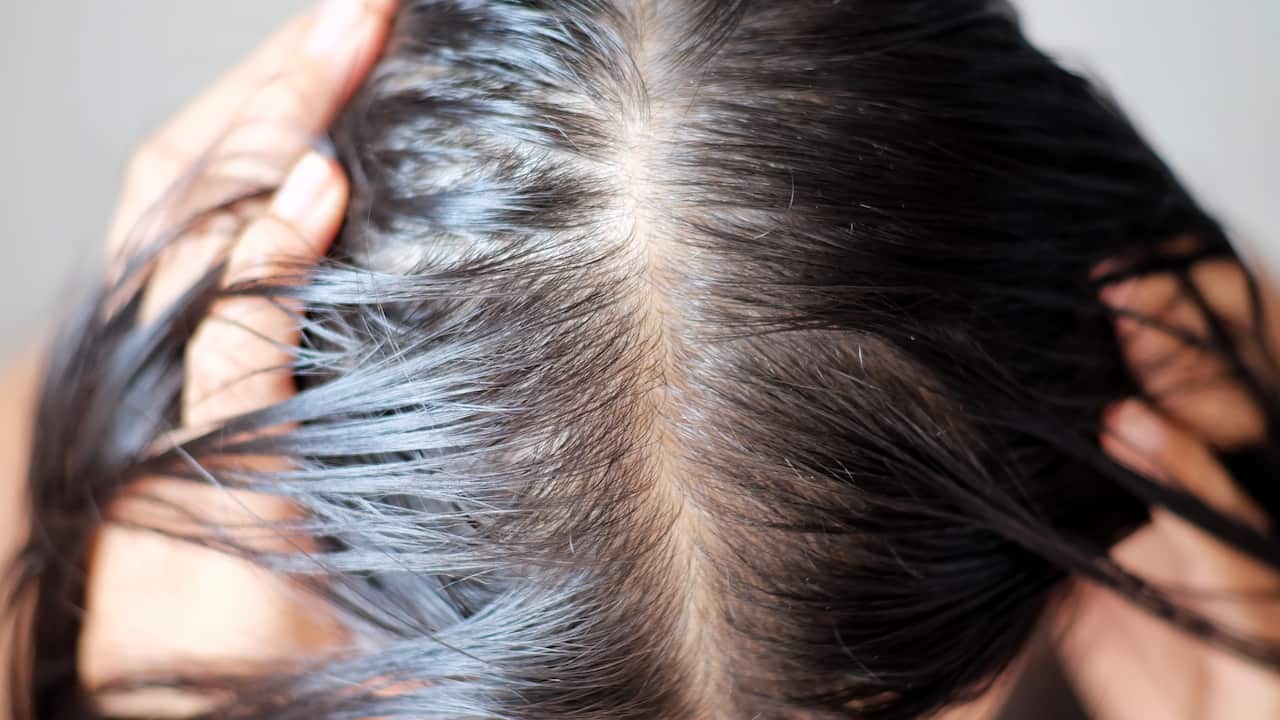 traction alopecia