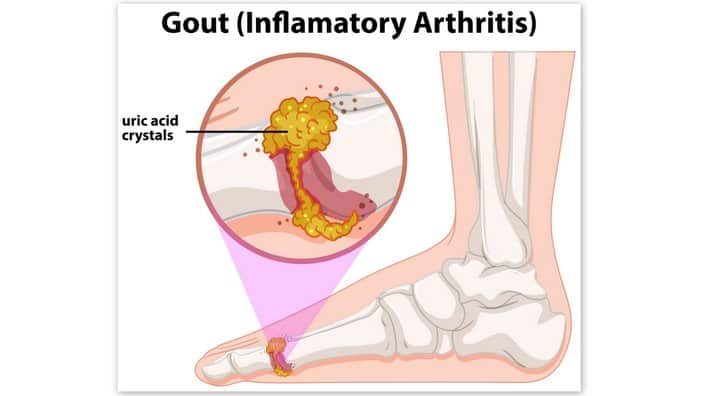 The uric acid can form needle-like crystals in a joint, and the joint can suddenly become very painful, red, hot and swollen.