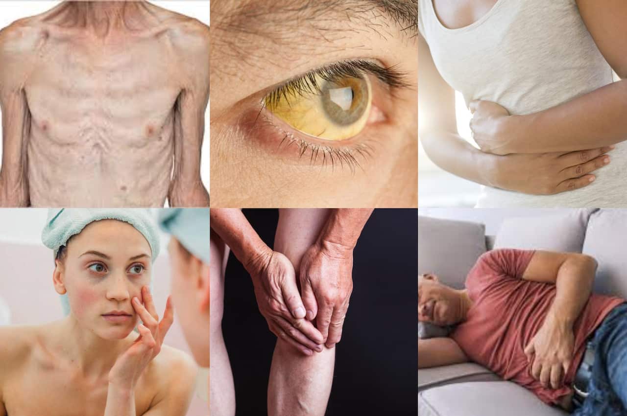 The symptoms of hepatitis may include muscle wasting, jaundice, upset stomach, skin irritation, muscle joint pain and bowel problems