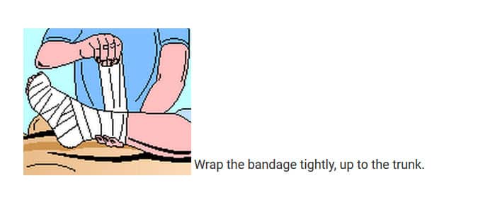 Pressure Immobilisation