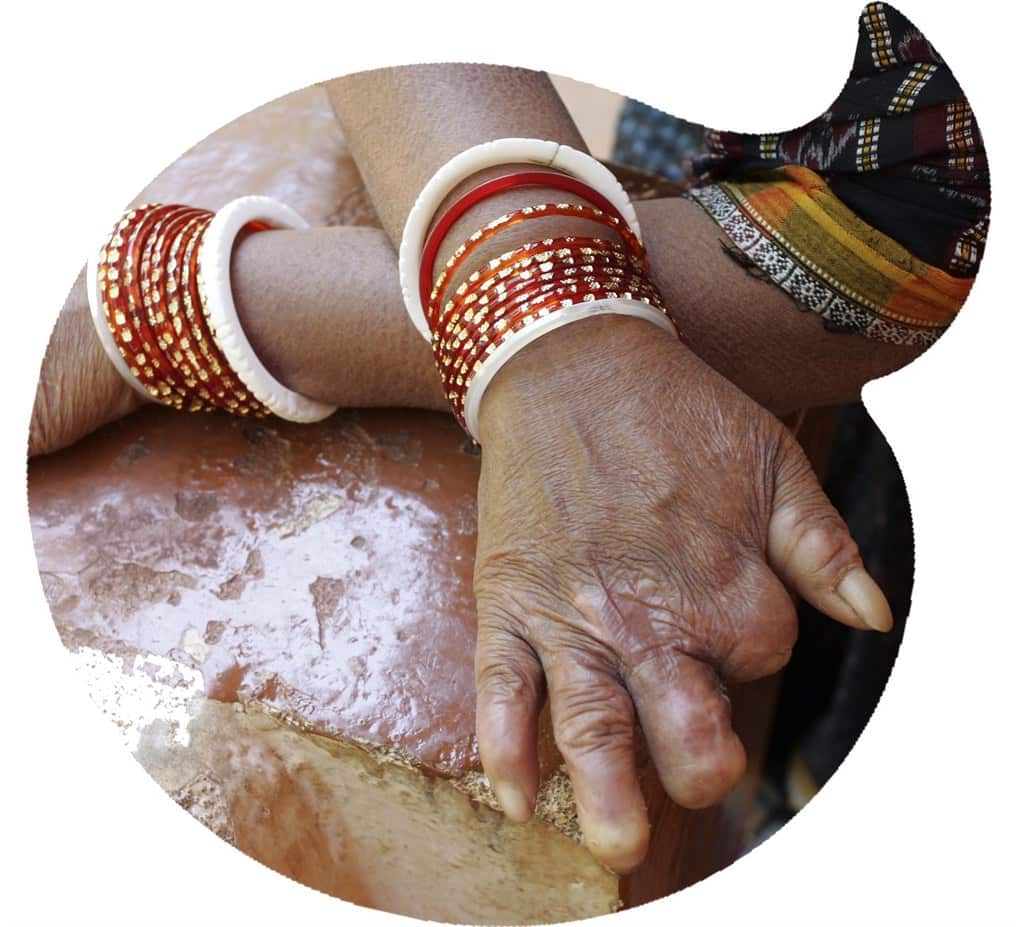 World Leprocy Day - The symptoms of leprosy sometimes take years to emerge.