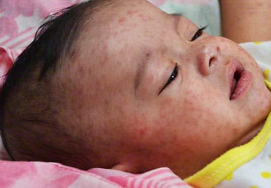 Three NSW measles cases in under a week