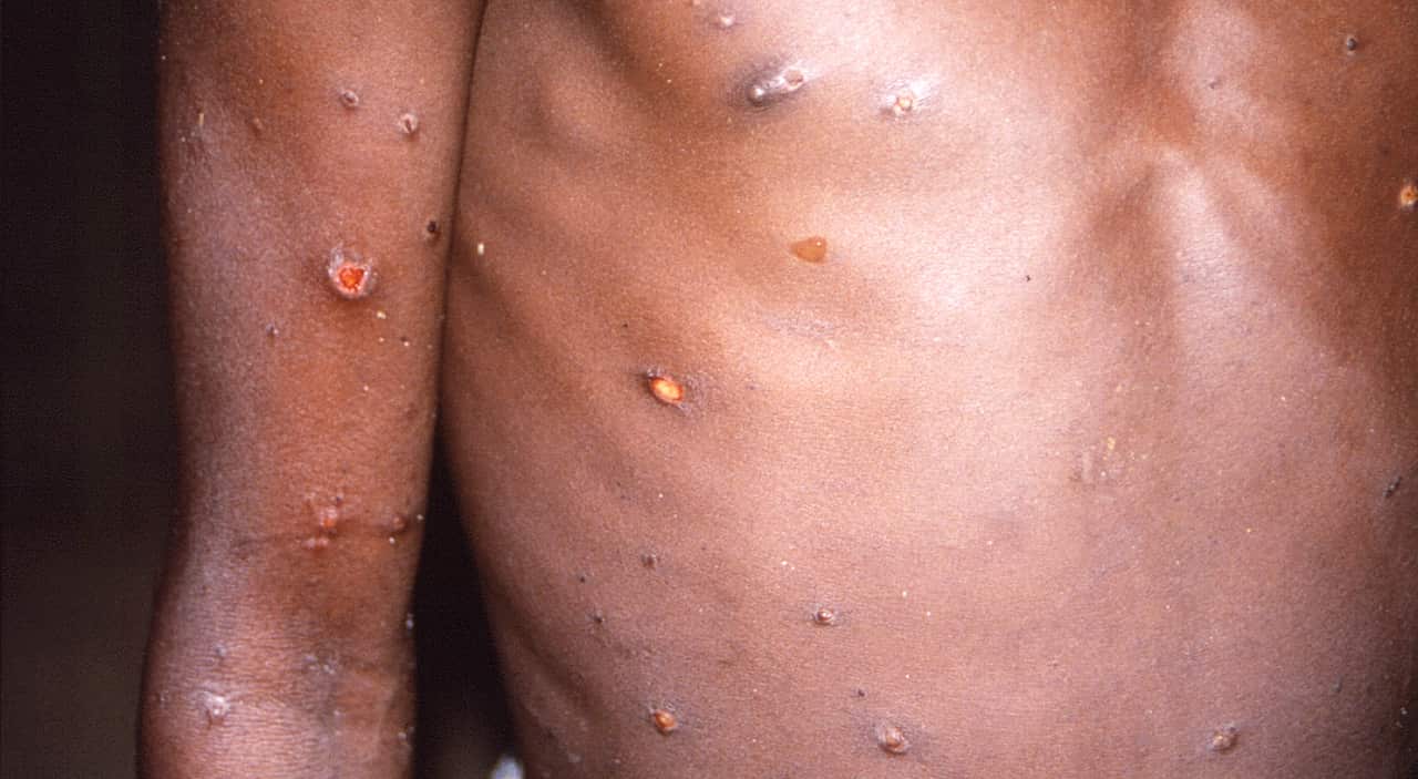 Signs of monkey pox