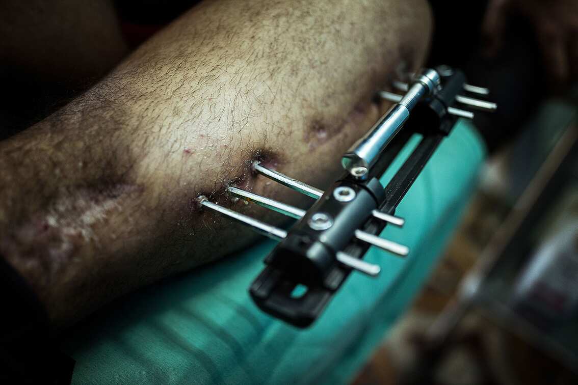 GAZA. 3rd March 2020. Despite everything he has been through so far he has hope that his life is going to be better.