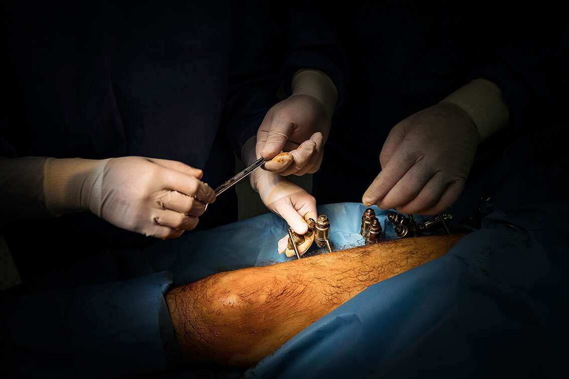 GAZA. 4th March 2020. Surgeons prepare to operate on Ismail Abu Wared.  Al-Awda, hospital patients suffering from osteomyelitis are kept in isolation rooms to treat infection. No new bone plantations can be performed while the infection is present.