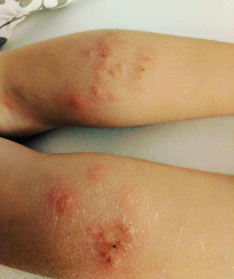 Seven-year-old Molly Reid was left with sores, ruining the family holiday