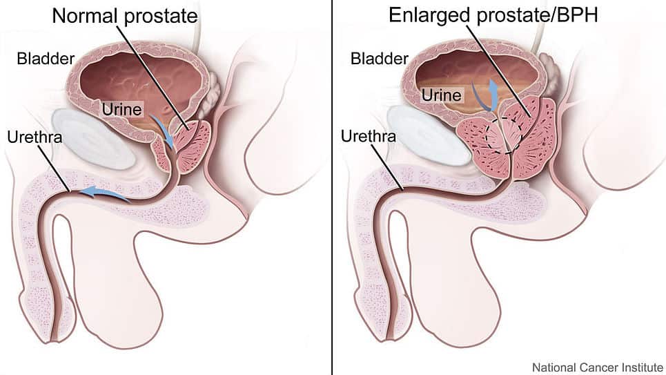 Prostate