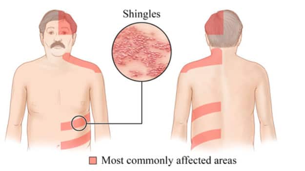The shingles rash usually develops on one side of the body