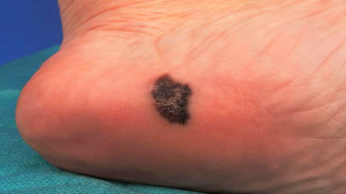 Melanoma cancer