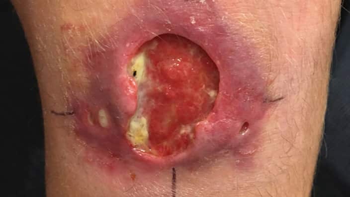 An example of flesh-eating caused an infectious disease called Buruli ulcer