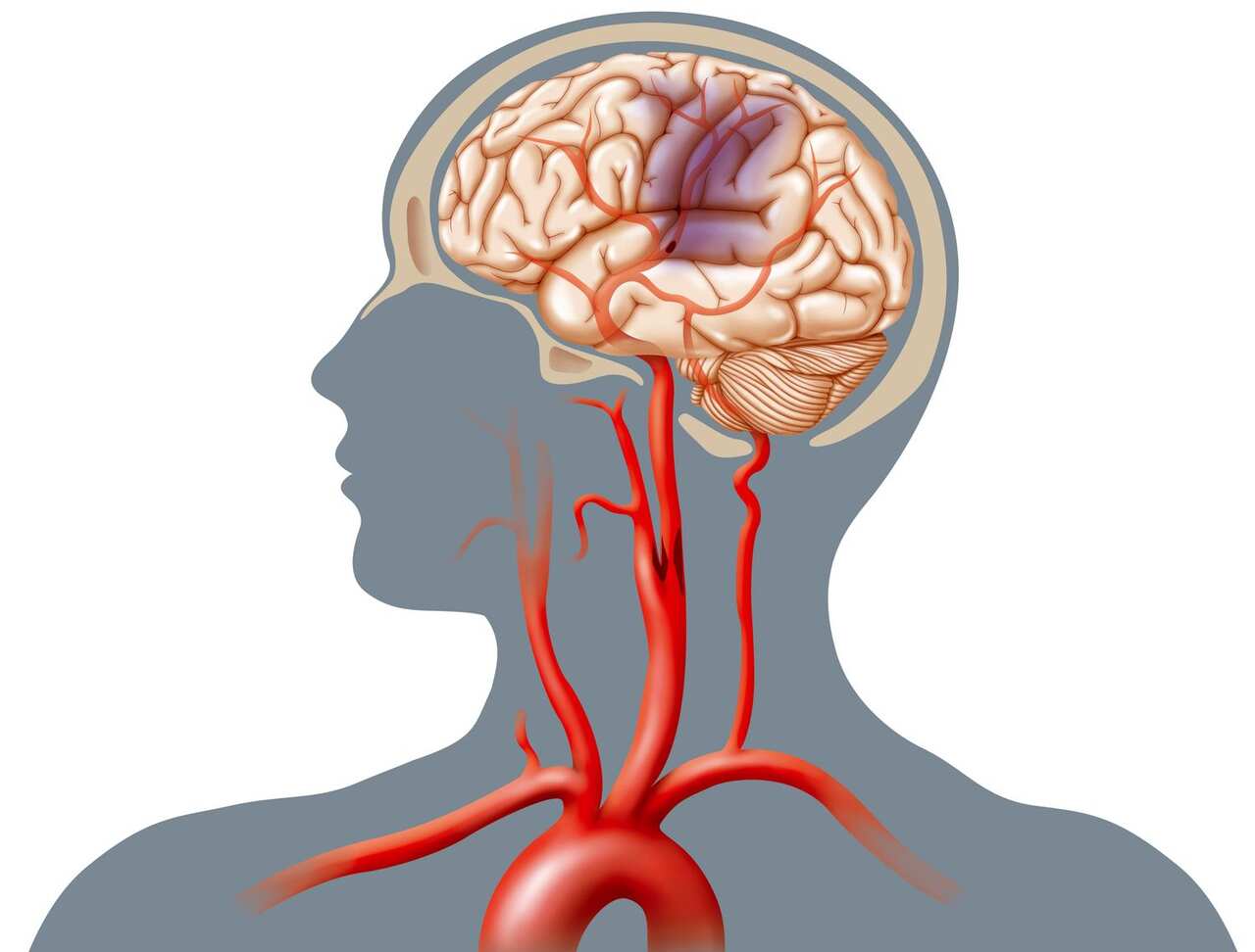 "Mini" strokes Illustration of a cerebrovascular accident (CVA) caused by an occlusion (atheromatous plaque which diminishes or obstructs the arterial lumen) in the carotid. 