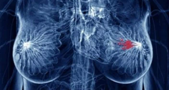 ရင္သားကင္ဆာ