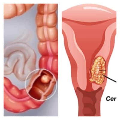 Bowel and Cervical Cancers 